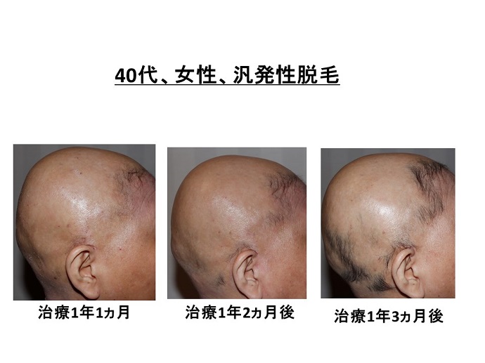 円形脱毛症　病院